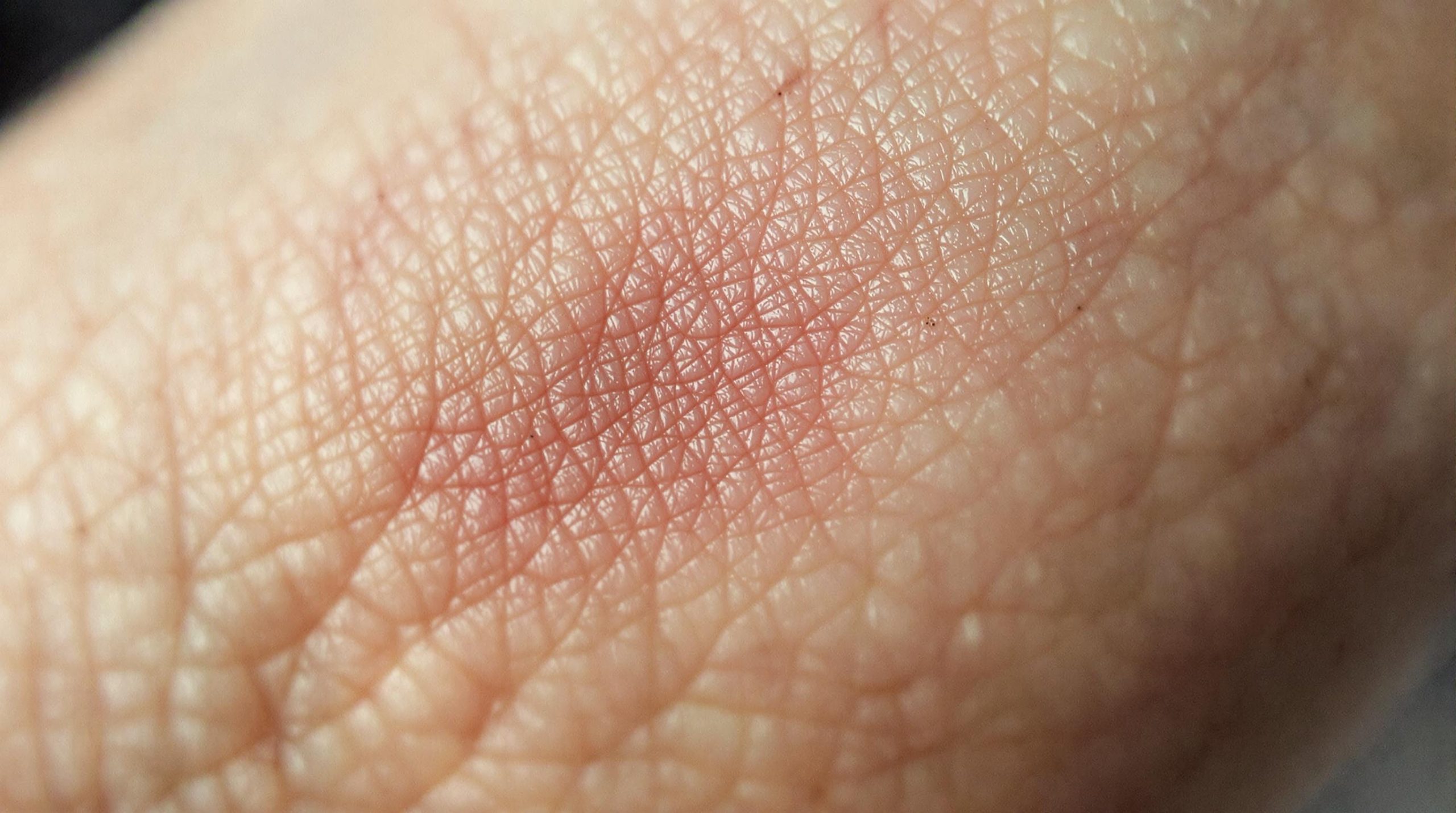 Pourquoi une vieille cicatrice peut-elle gonfler et que faire ? - My Beauty Vedia