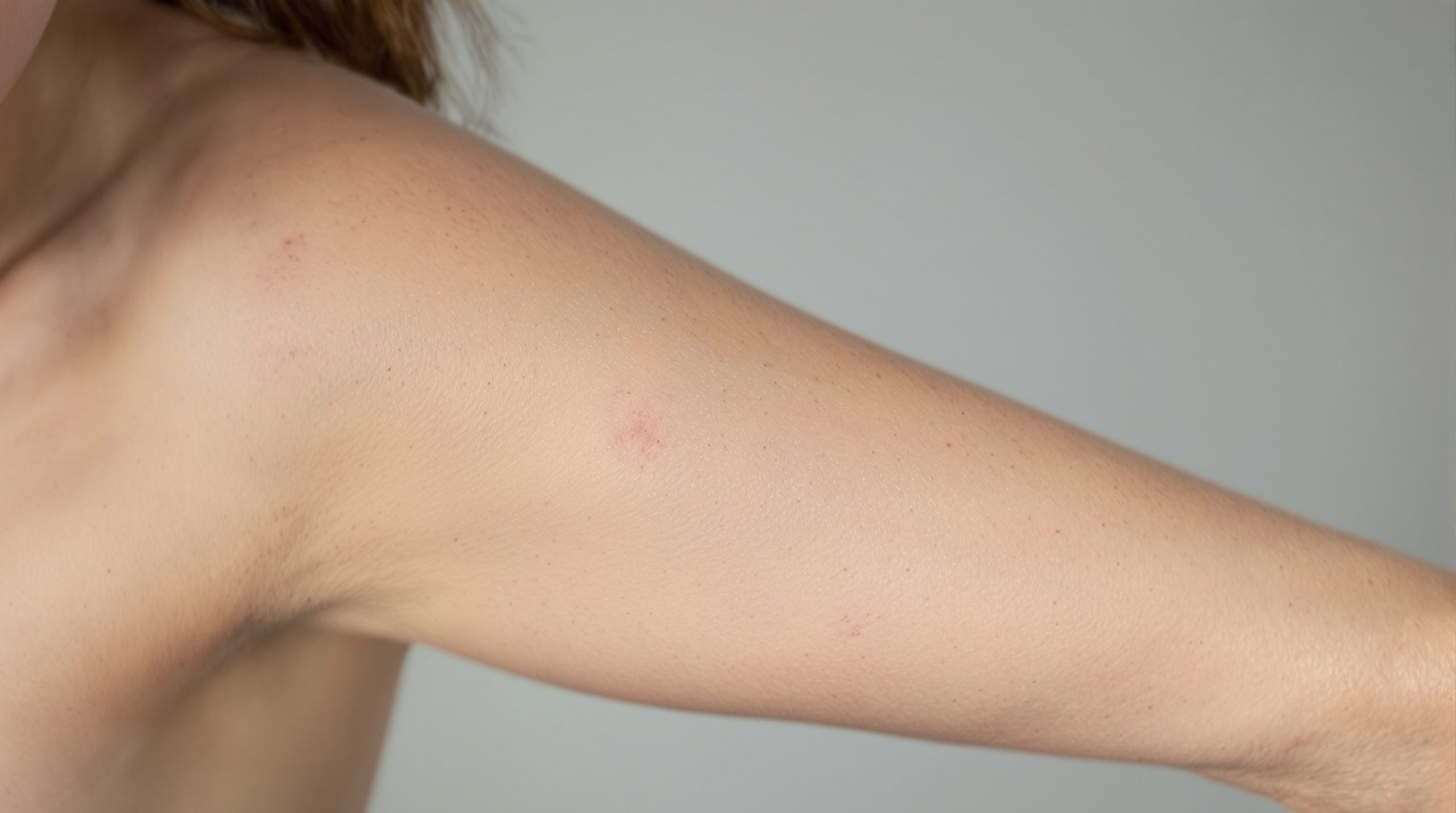 Kératose pilaire : l'essentiel à savoir - My Beauty Vedia